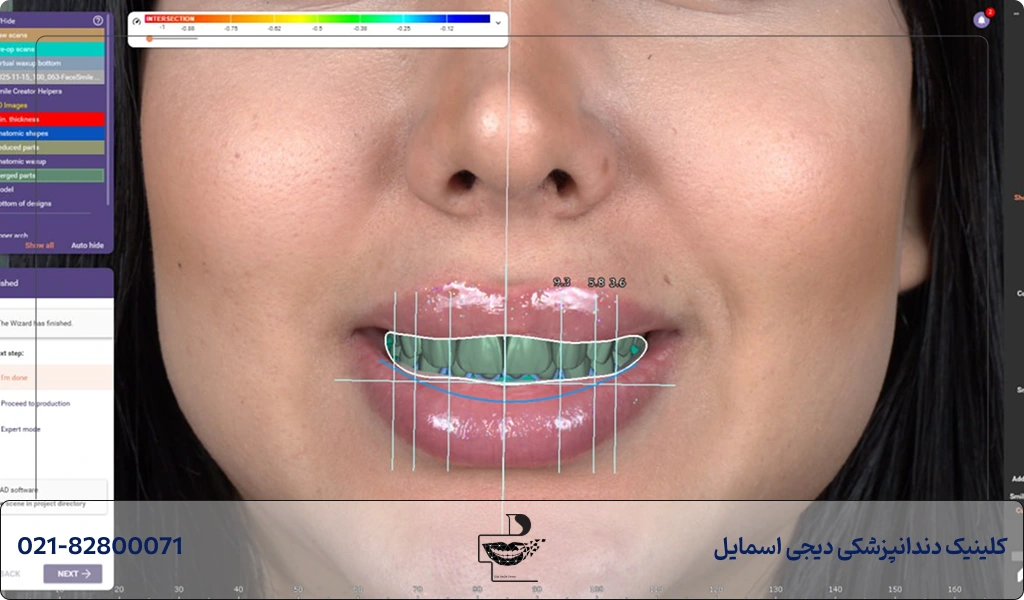 طراحی دیجیتال کامپوزیت دندان