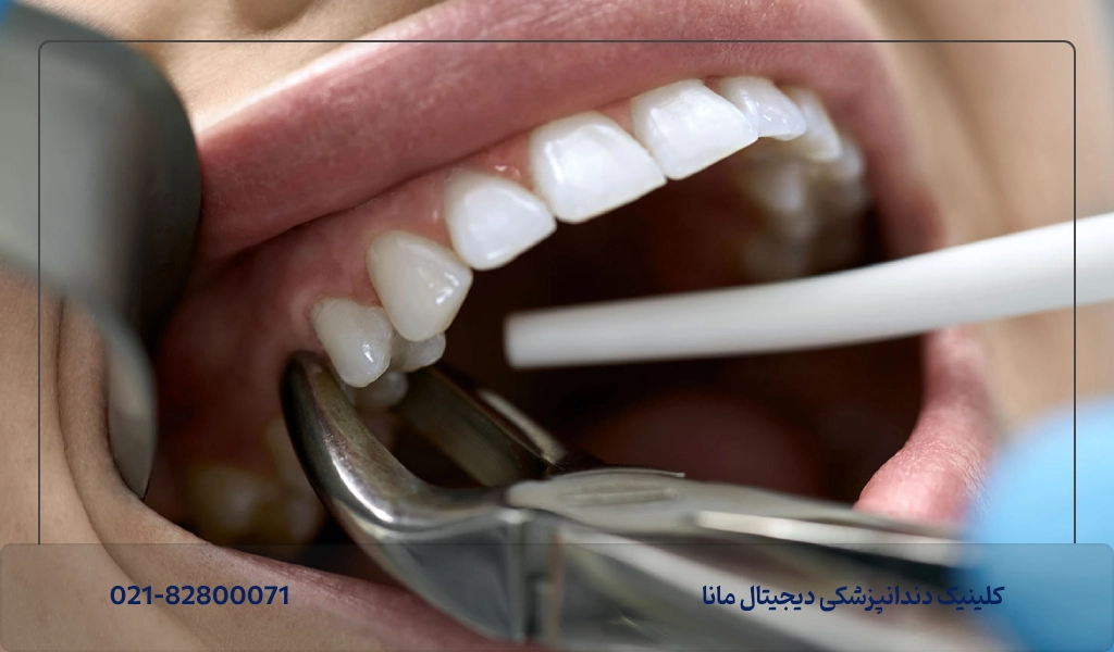 بهترین زمان برای کاشت ایمپلنت بعد از کشیدن دندان