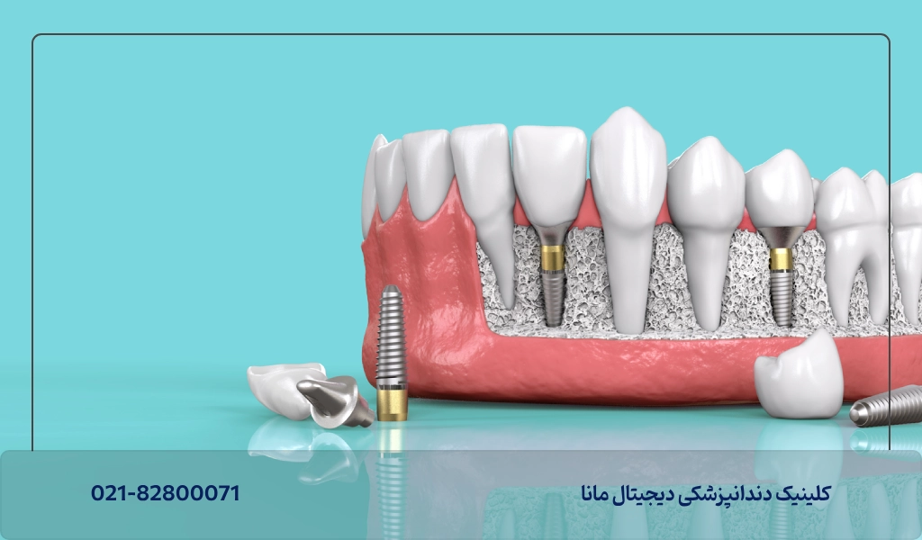 ۶- تفاوت ایمپلنت دیجیتال و سنتی در سرعت درمان