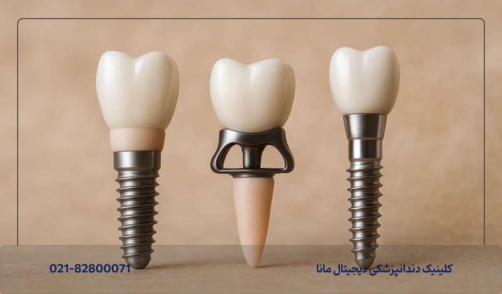 ایمپلنت دیجیتال یا معمولی؛ کدوم بهتره؟