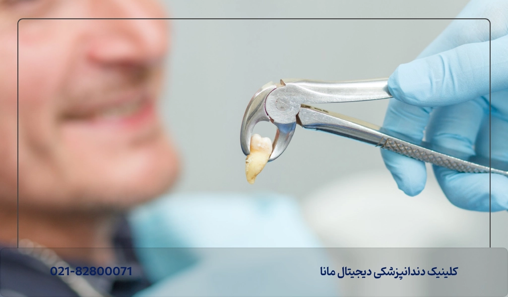 عوارض تأخیر در کاشت ایمپلنت دندان بعد از کشیدن دندان