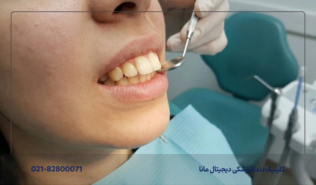روش انجام کامپوزیت دندان خرگوشی