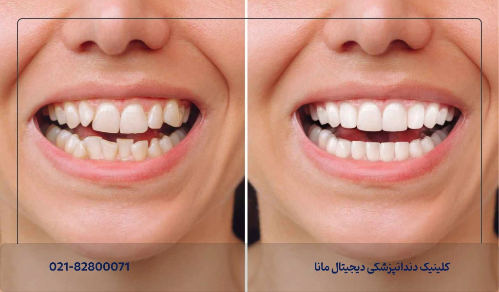 عکس کامپوزیت دندان خرگوشی؛ چه کسانی باید کامپوزیت دندان خرگوشی انجام دهند؟