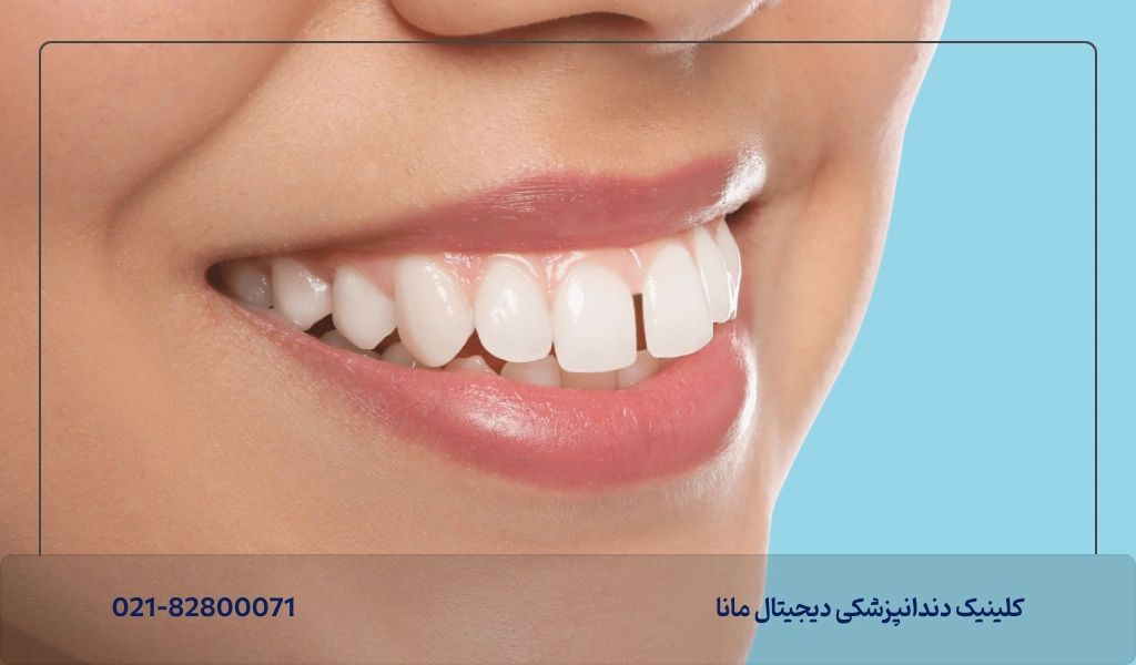 منظور از کامپوزیت دندان خرگوشی چیست؟