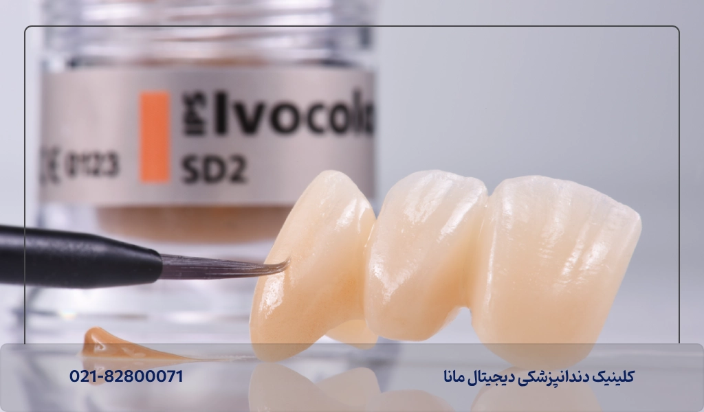 انواع رنگ برای کامپوزیت دندان