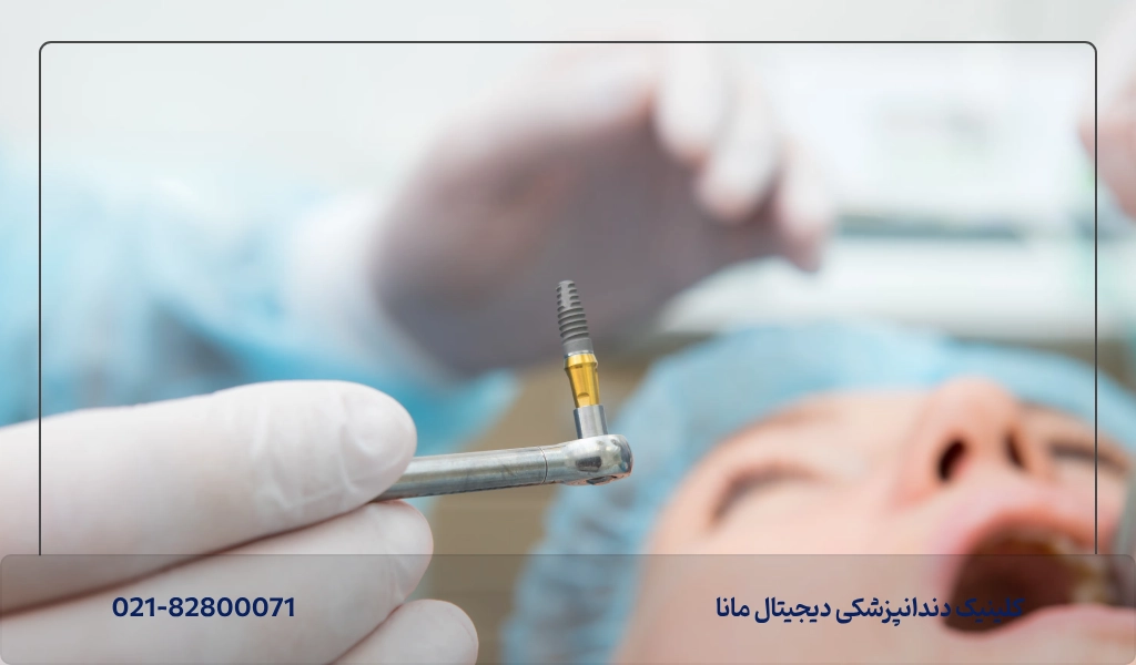 راه های پیشگیری از خراب شدن دندان ایمپلنت