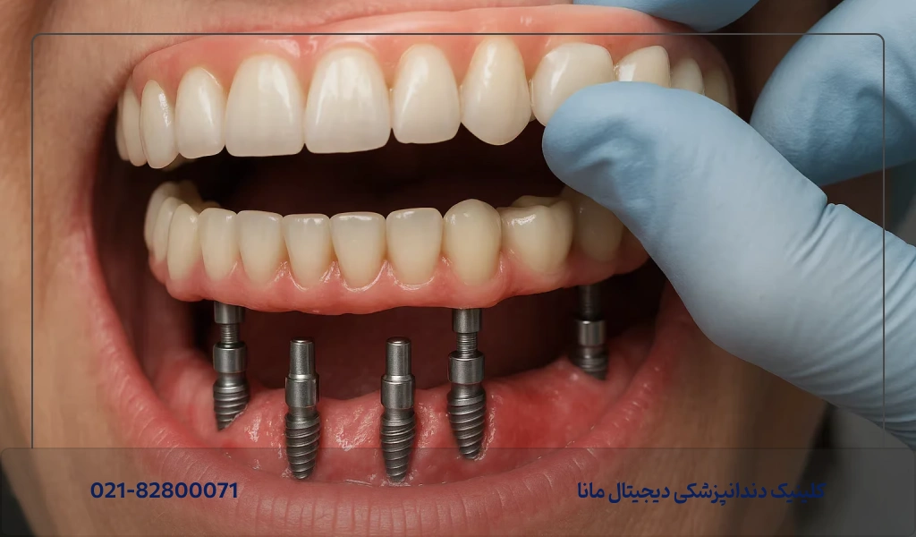 درد دندان ایمپلنت شده بعد از ۱ ماه