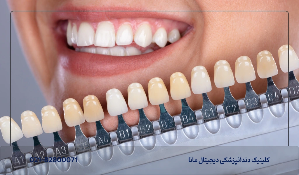 آیا بعد از اجرا کامپوزیت دندان میتوان رنگ آن را تغییر داد؟
