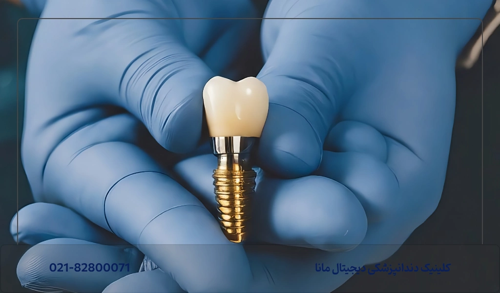ایمپلنت دندان بعد از چند سال خراب میشود؟