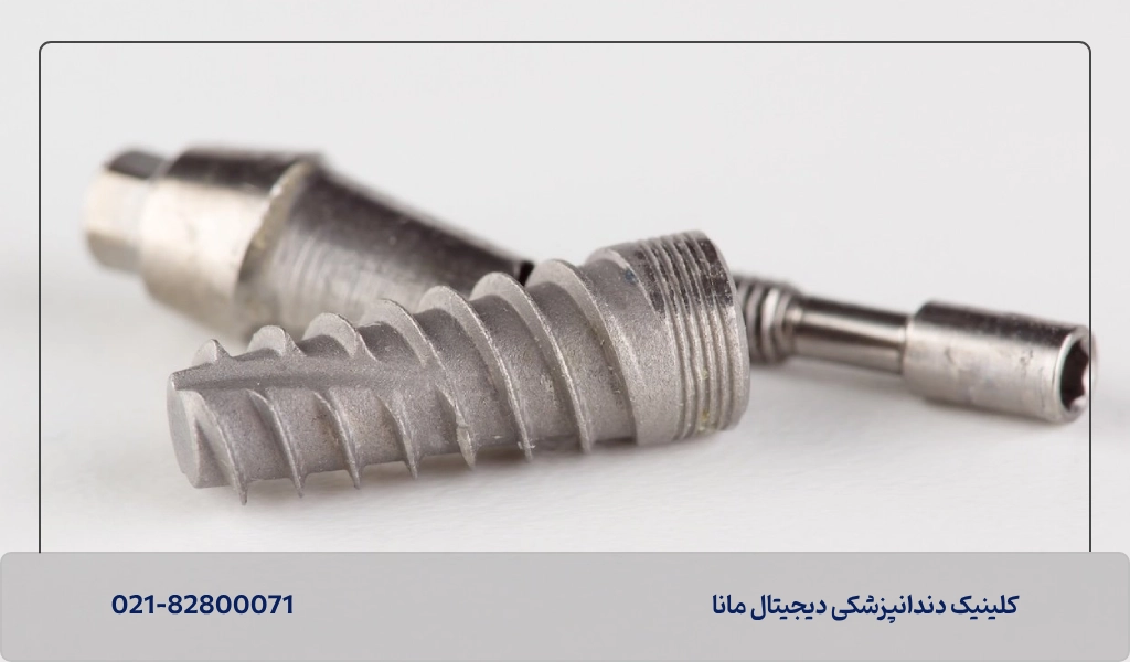 طول عمر ایمپلنت سوئیسی