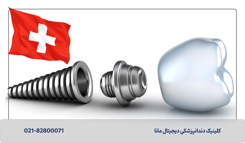 ایمپلنت سوئیسی چیست؟