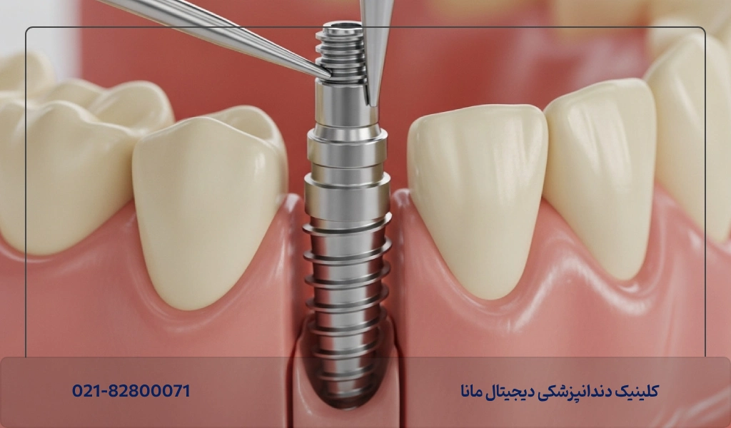 عوارض و معایب ایمپلنت های دندانی آلمانی