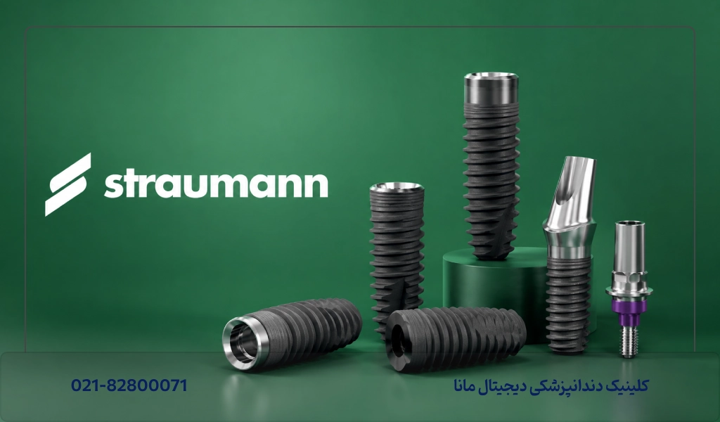 شرایط اقساط کاشت ایمپلنت اشترومن در مانا