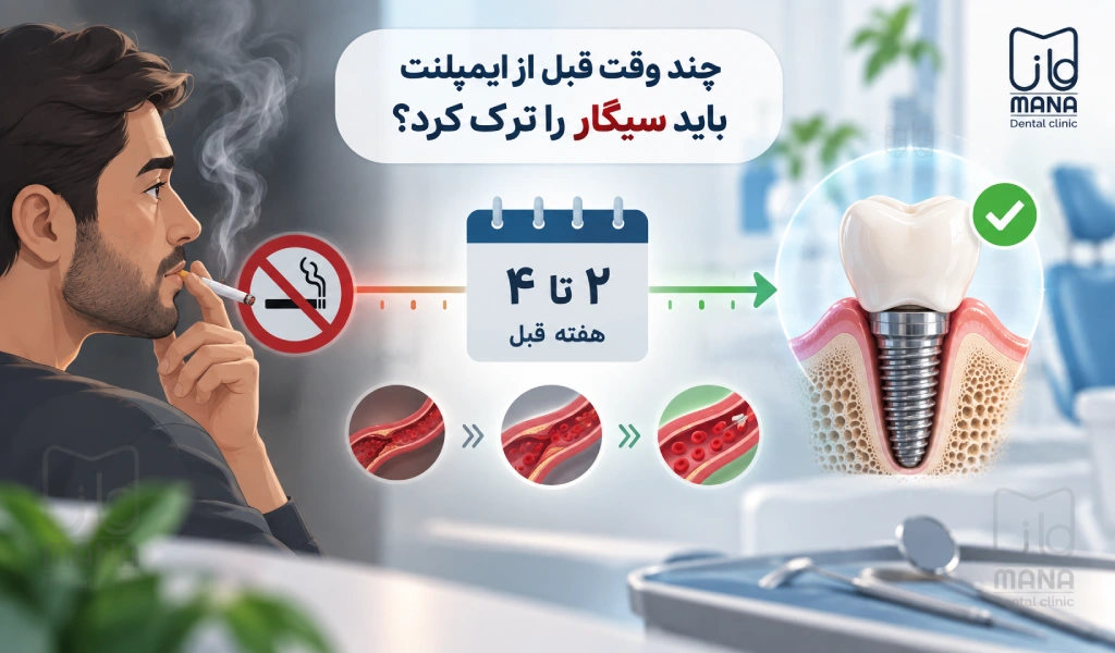 چند وقت قبل از ایمپلنت باید سیگار را ترک کرد؟