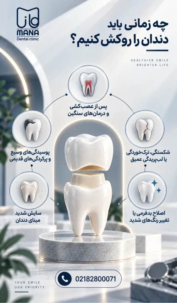ماندگاری روکش دندان چقدر است؟