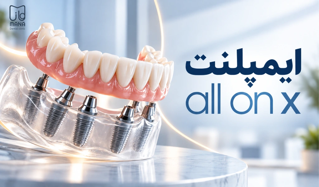 ایمپلنت all on x چیست؟