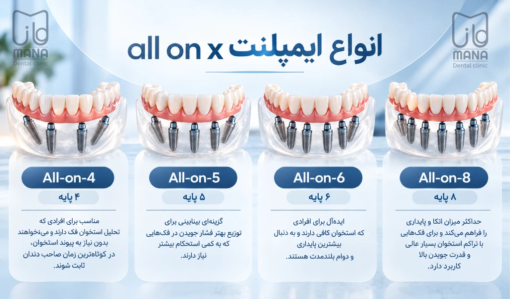 انواع ایمپلنت all on x