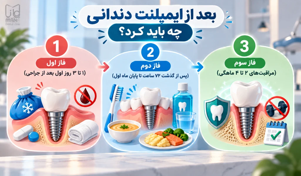 بعد از ایمپلنت دندانی چه باید کرد؟