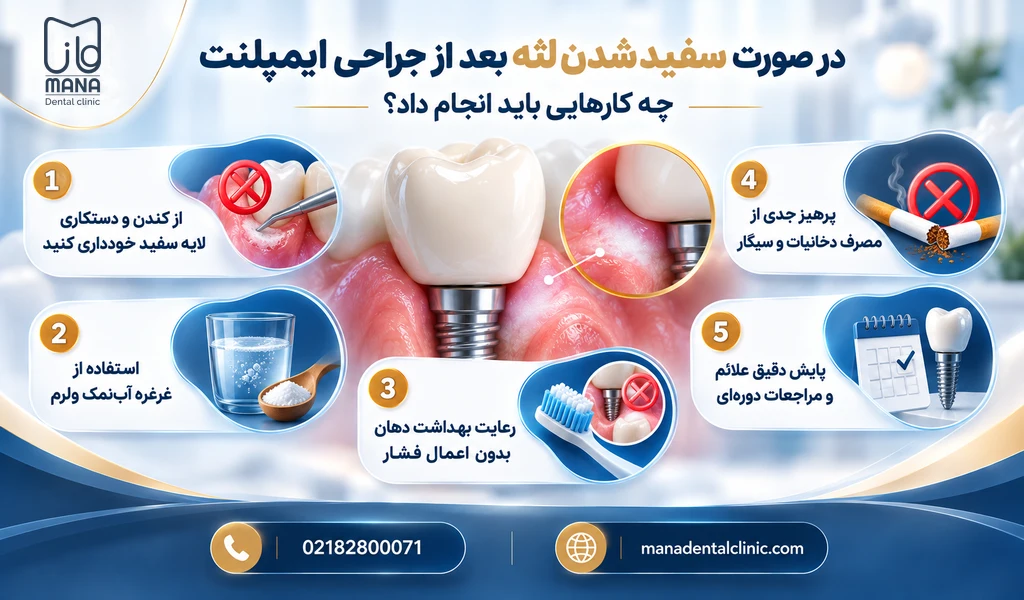 در صورت سفید شدن لثه بعد از جراحی ایمپلنت چه کارهایی باید انجام داد؟
