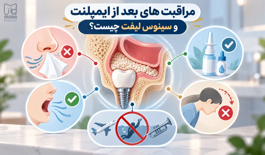 مراقبت های بعد از ایمپلنت و سینوس لیفت چیست؟