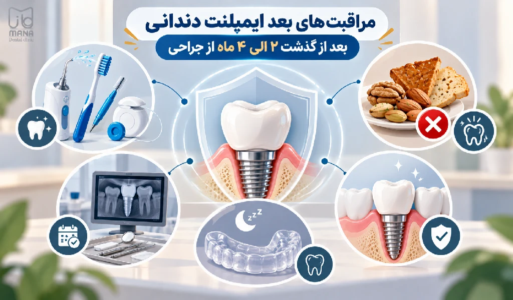 مراقبت های بعد ایمپلنت دندانی بعد از گذشت ۲ الی ۴ ماه از جراحی
